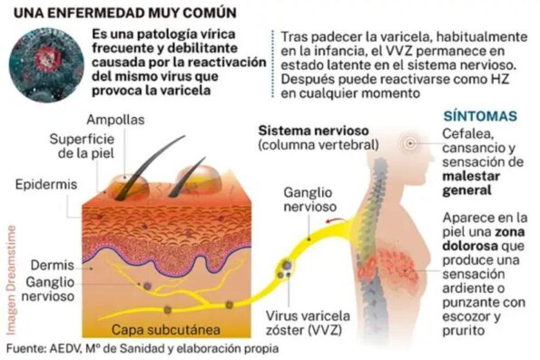 Artículo del Herpes-zoster